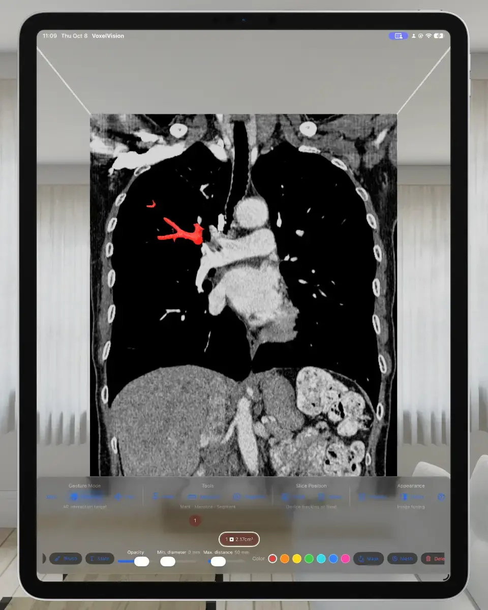 VoxelVision AR Medical Imaging screenshot 3